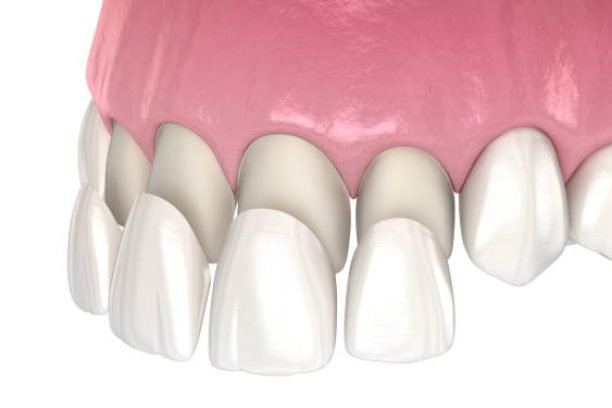 Veneer installation procedure over central incisor and lateral incisor. Medically accurate tooth 3D illustration