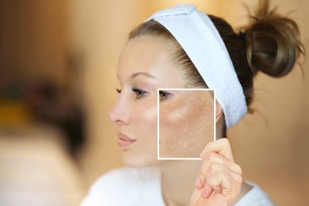 Dark spots, freckles,hyperpigmentation(melasma or chloasma),concept - skin lightening, skin whitening, fruit acids,AHA, Skin Brightening