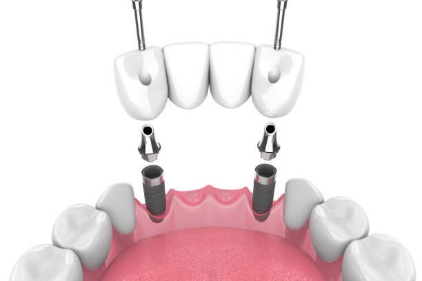 3d render of jaw with dental bridge supported by implants over white background