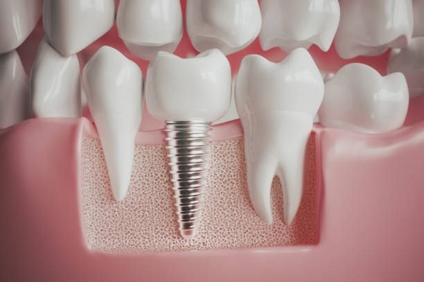 Implant next to a healthy molar -- 3D rendering