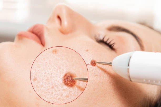 Electrocoagulation and laser cosmelotogy. Dermatologist using a professional electrocautery for removing mole. Zoomed area of melanoma.