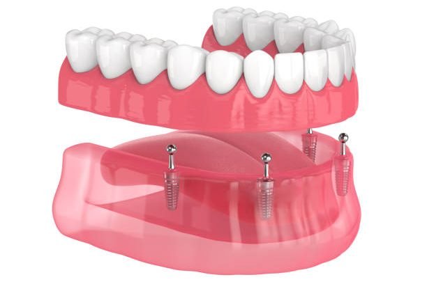 All-on-4 removable, implants supported, overdenture installation over white background