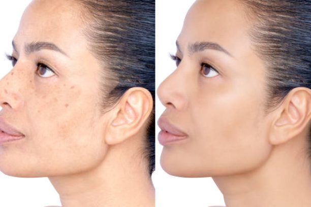 Before and after Healing removing Problem of facial Wrinkles, melasma, Dark spots, freckles, dry skin on middle age woman face skin care and Cosmetology concept. Studio headshot isolated on white.