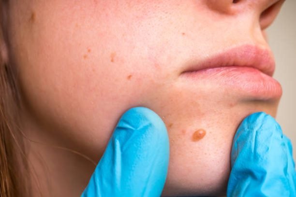 Woman with birthmark on her face, skin tags removal - cosmetic surgery