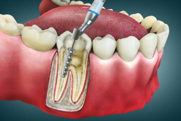 4D Root Canal Image