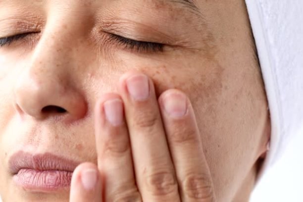 Female suffering from hyperpigmentation (melasma) is  using face serum for skin brightening. 
She has dark spots on her face and  her eyes are closed.