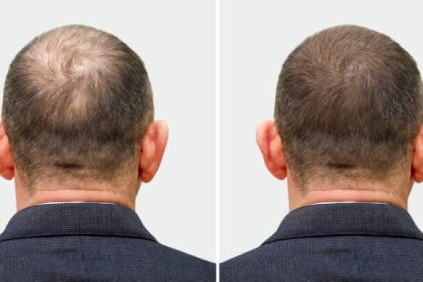 The head of a balding man before and after hair transplant surgery. A man losing his hair has become shaggy. An advertising poster for a hair transplant clinic. Treatment of baldness