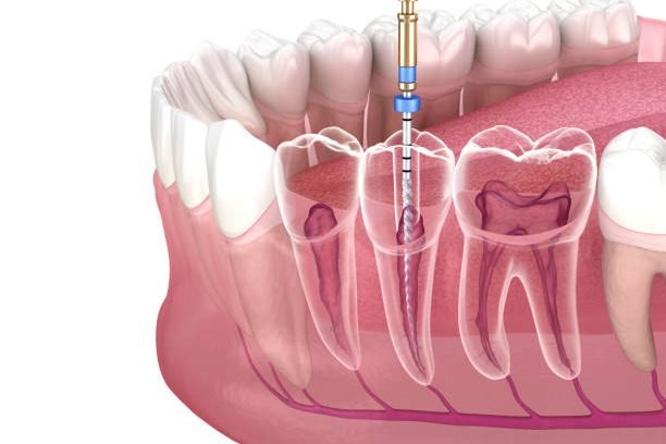 Endodontic root canal treatment process. Medically accurate tooth 3D illustration.