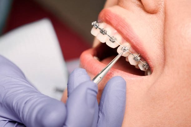 Close up of dentist hand in serial glove putting elastic rubber band on patient brackets. Woman with wired metal braces on teeth receiving orthodontic treatment in dental clinic. Concept of dentistry.