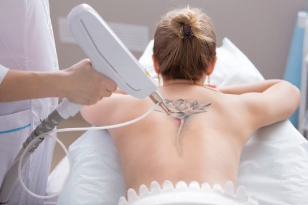 Tattoo Removal Laser