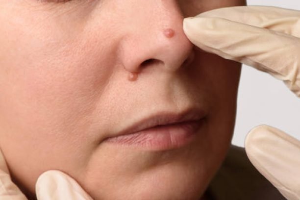 Diagnosis of skin mole or nevus on woman's face. Doctor's hands in surgical gloves examining nevi on nose. Checking moles concept. Closeup